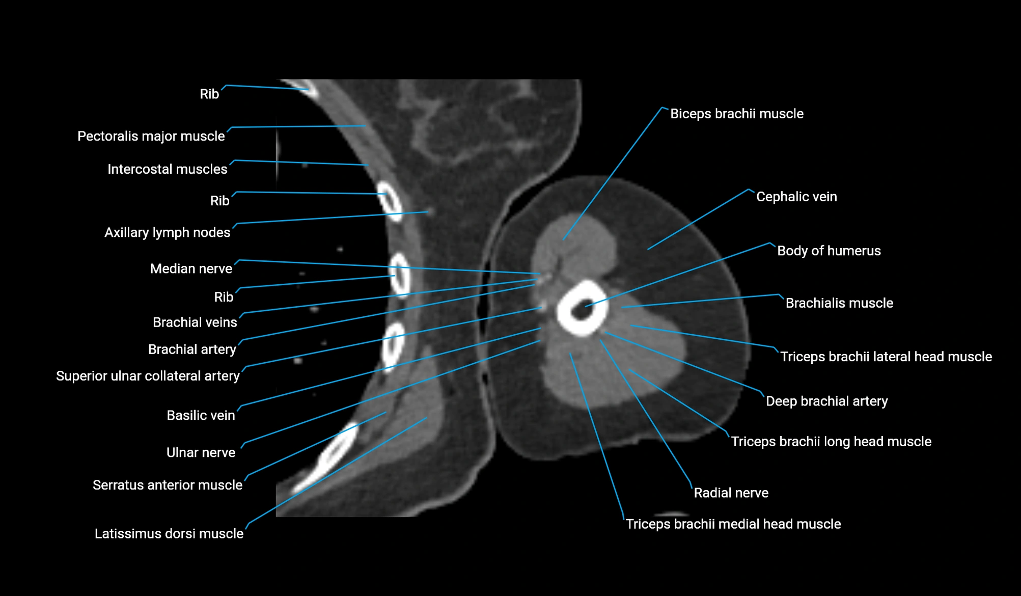 CT upper arm axial  cross sectional anatomy labelled radiology image -00232.webp